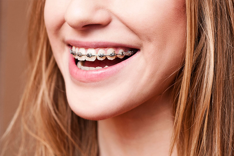 Orthodontics in San Diego