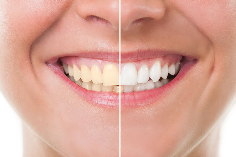 Teeth Whitening in San Diego