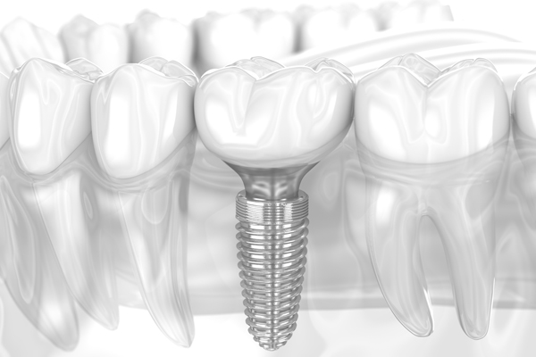 What Materials Are Used To Make An Implant Crown?